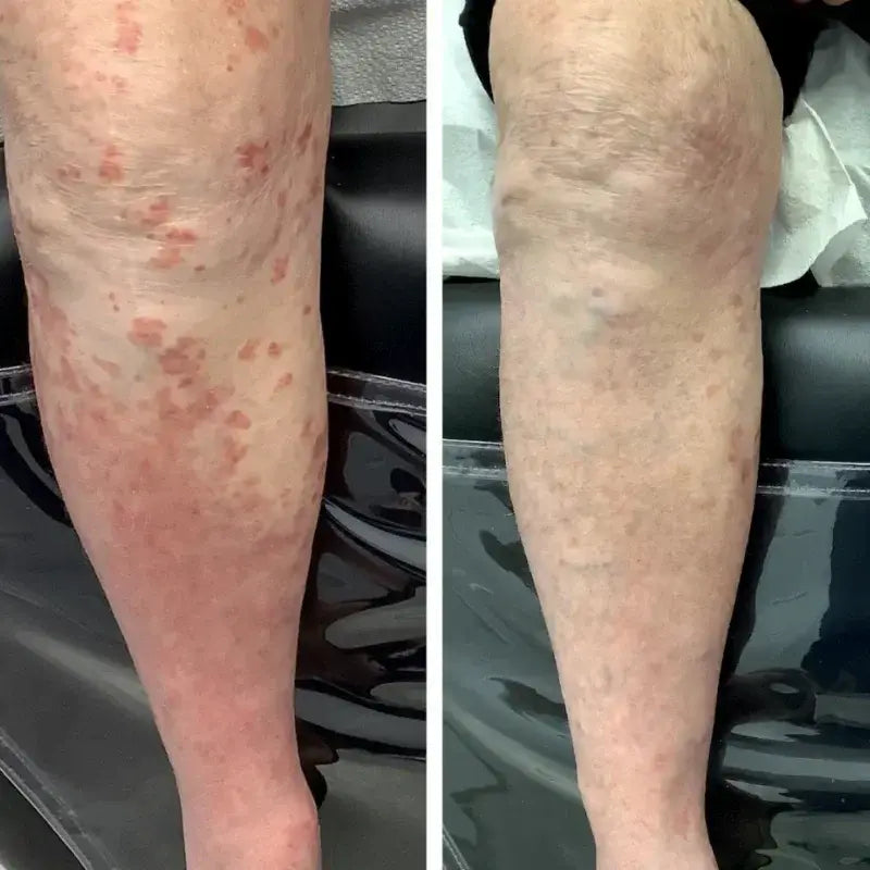 DermaFlora™ maisto papildas | Sustabdykite odos išbėrimus ir atkurkite žarnyno funkciją per 1 savaitę